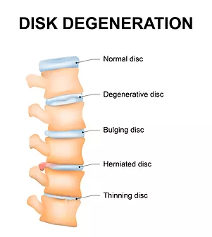 disk degeneration